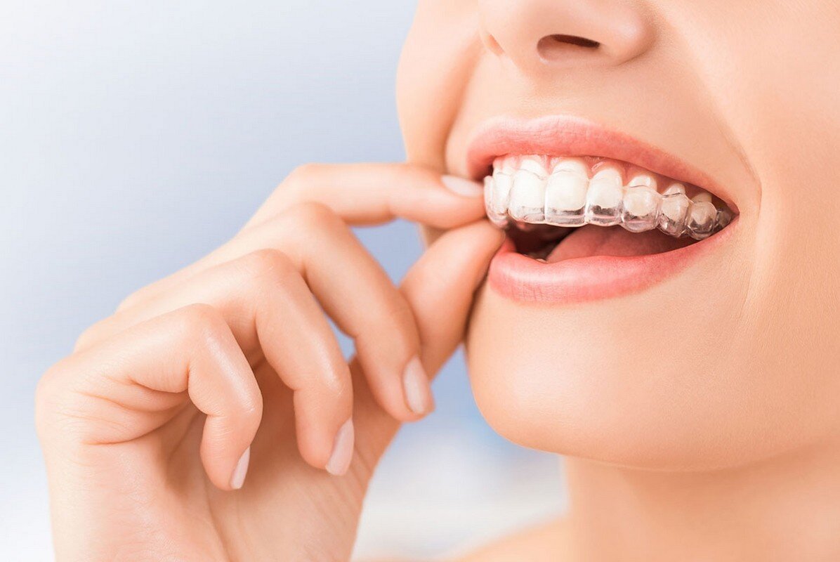 apparecchio dentale trasparente