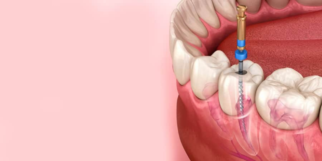 illustrazione del trattamento endodontico del dente